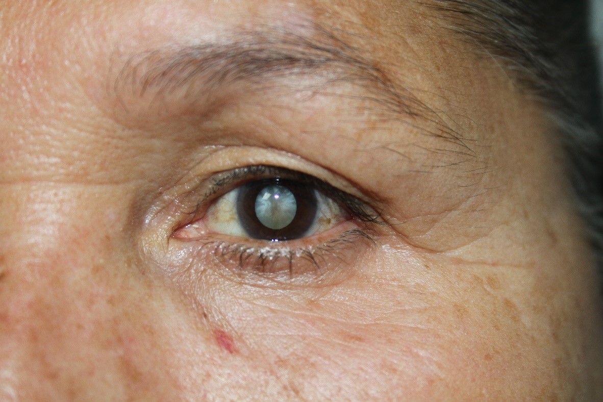 Eye Cataract